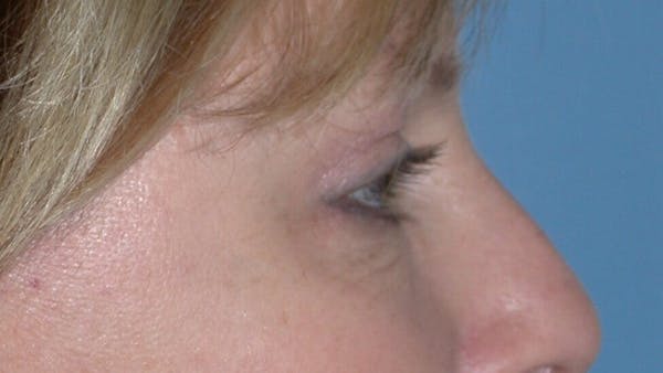 Eyelid Lift Gallery Before & After Gallery - Patient 4756946 - Image 8