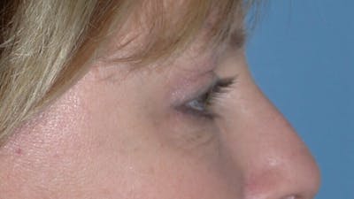 Eyelid Lift Before & After Gallery - Patient 4756946 - Image 8