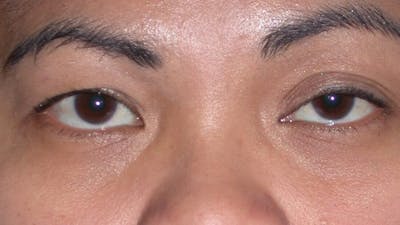 Eyelid Lift Gallery Before & After Gallery - Patient 4756947 - Image 1