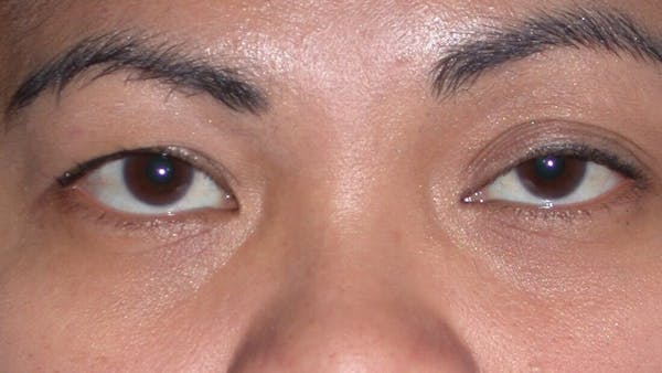 Eyelid Lift Before & After Gallery - Patient 4756947 - Image 1