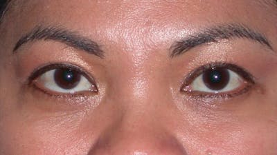 Eyelid Lift Before & After Gallery - Patient 4756947 - Image 2