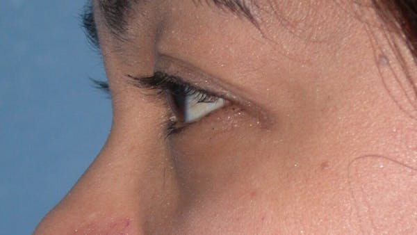 Eyelid Lift Gallery Before & After Gallery - Patient 4756947 - Image 3