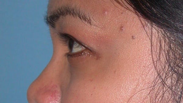 Eyelid Lift Gallery Before & After Gallery - Patient 4756947 - Image 4