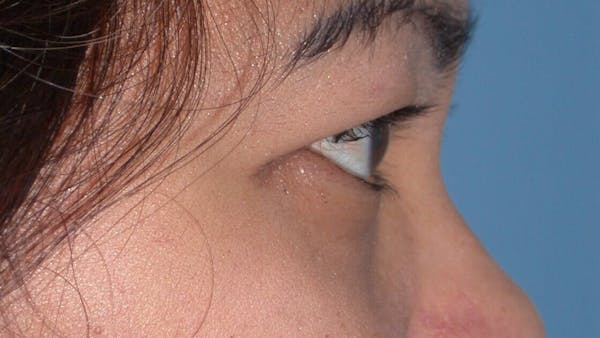 Eyelid Lift Gallery Before & After Gallery - Patient 4756947 - Image 5