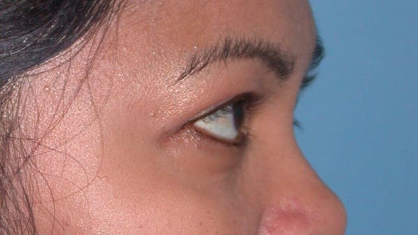 Eyelid Lift Gallery Before & After Gallery - Patient 4756947 - Image 6