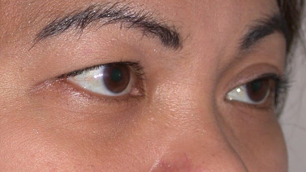 Eyelid Lift Gallery Before & After Gallery - Patient 4756947 - Image 7