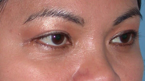 Eyelid Lift Gallery Before & After Gallery - Patient 4756947 - Image 8