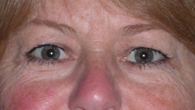 Eyelid Lift Gallery Before & After Gallery - Patient 4756951 - Image 1