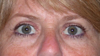 Eyelid Lift Gallery Before & After Gallery - Patient 4756951 - Image 2