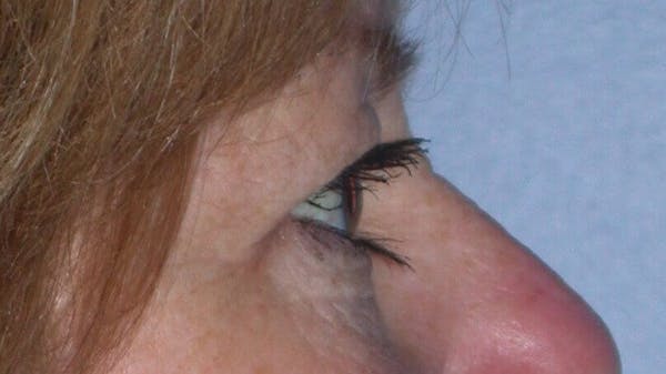 Eyelid Lift Gallery Before & After Gallery - Patient 4756951 - Image 3