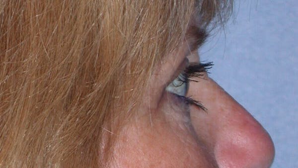 Eyelid Lift Gallery Before & After Gallery - Patient 4756951 - Image 4