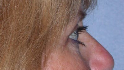 Eyelid Lift Before & After Gallery - Patient 4756951 - Image 4