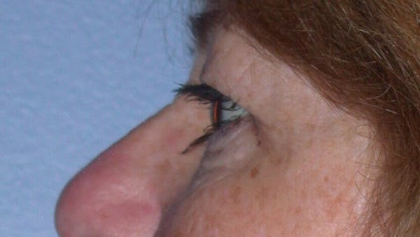 Eyelid Lift Gallery Before & After Gallery - Patient 4756951 - Image 5