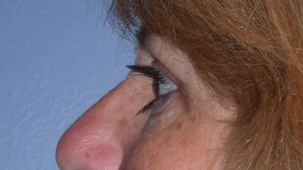 Eyelid Lift Gallery Before & After Gallery - Patient 4756951 - Image 6