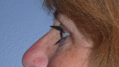 Eyelid Lift Before & After Gallery - Patient 4756951 - Image 6