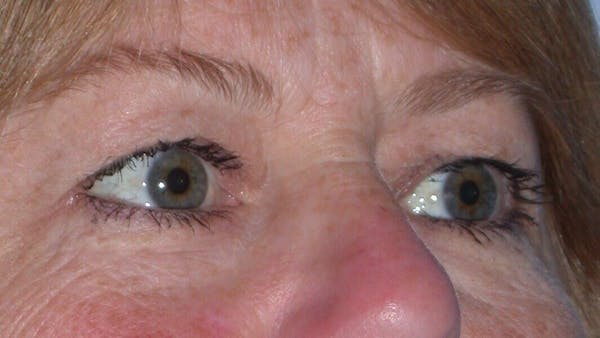 Eyelid Lift Gallery Before & After Gallery - Patient 4756951 - Image 7