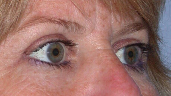 Eyelid Lift Gallery Before & After Gallery - Patient 4756951 - Image 8