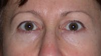 Eyelid Lift Gallery Before & After Gallery - Patient 4756956 - Image 1