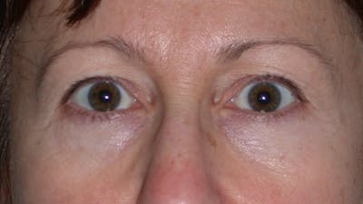 Eyelid Lift Gallery Before & After Gallery - Patient 4756956 - Image 1