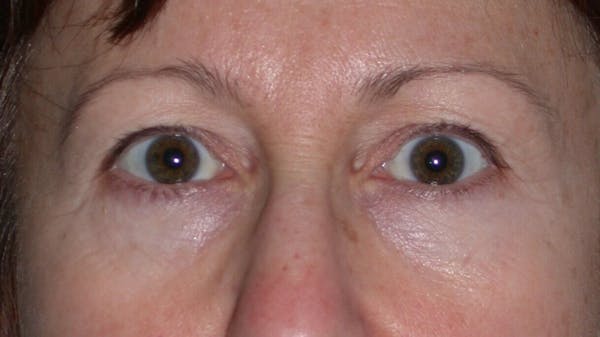Eyelid Lift Before & After Gallery - Patient 4756956 - Image 1