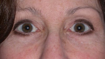 Eyelid Lift Gallery Before & After Gallery - Patient 4756956 - Image 2