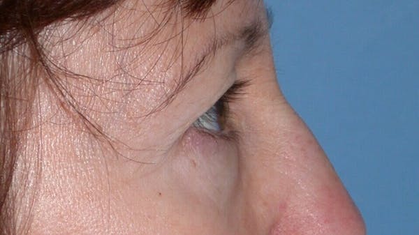 Eyelid Lift Gallery Before & After Gallery - Patient 4756956 - Image 3