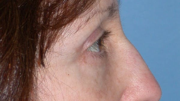 Eyelid Lift Gallery Before & After Gallery - Patient 4756956 - Image 4