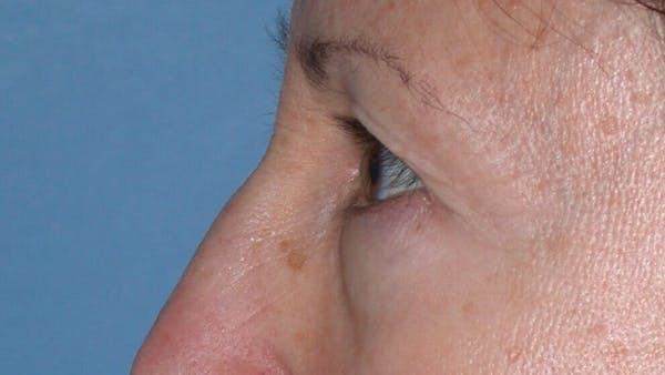 Eyelid Lift Gallery Before & After Gallery - Patient 4756956 - Image 5