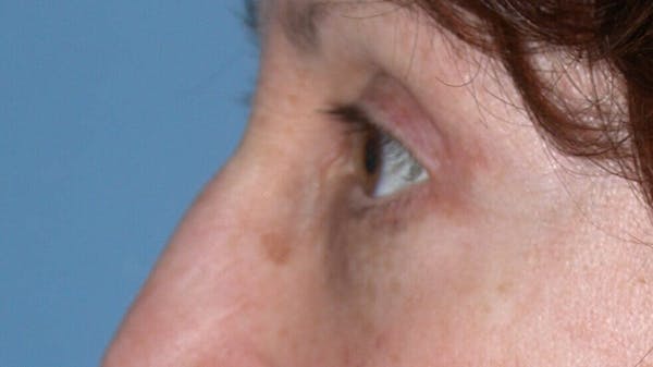 Eyelid Lift Gallery Before & After Gallery - Patient 4756956 - Image 6