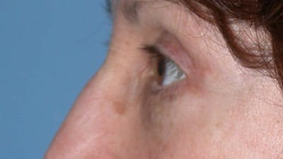 Eyelid Lift Before & After Gallery - Patient 4756956 - Image 6