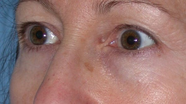 Eyelid Lift Gallery Before & After Gallery - Patient 4756956 - Image 7