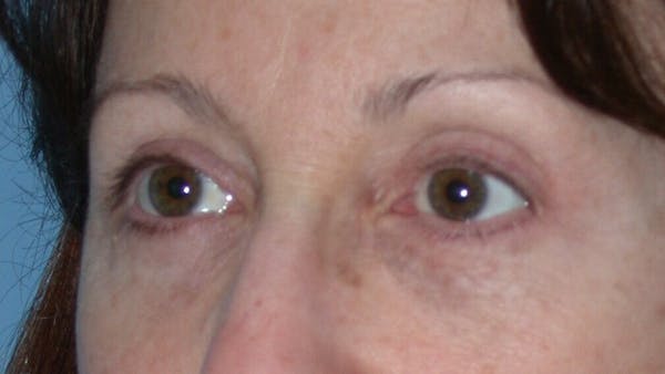 Eyelid Lift Gallery Before & After Gallery - Patient 4756956 - Image 8