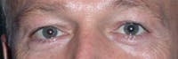 Eyelid Lift Gallery Before & After Gallery - Patient 4756957 - Image 1