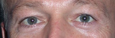 Eyelid Lift Gallery Before & After Gallery - Patient 4756957 - Image 1