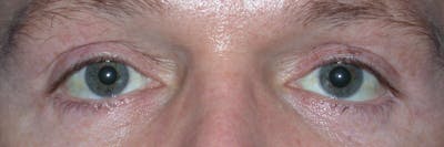 Eyelid Lift Before & After Gallery - Patient 4756957 - Image 2