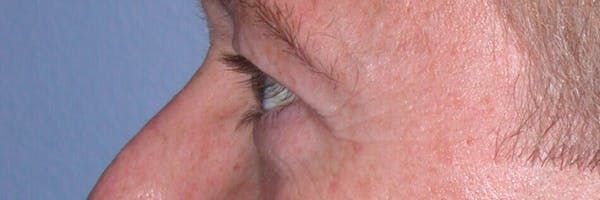 Eyelid Lift Gallery Before & After Gallery - Patient 4756957 - Image 3