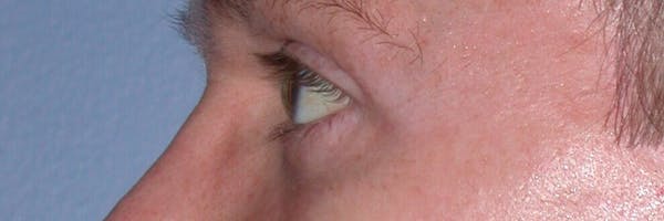 Eyelid Lift Gallery Before & After Gallery - Patient 4756957 - Image 4