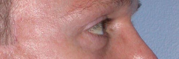 Eyelid Lift Gallery Before & After Gallery - Patient 4756957 - Image 6
