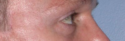 Eyelid Lift Before & After Gallery - Patient 4756957 - Image 6