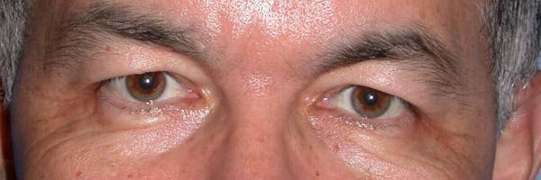 Eyelid Lift Before & After Gallery - Patient 4756964 - Image 1
