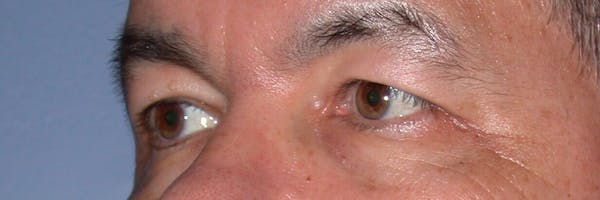 Eyelid Lift Gallery Before & After Gallery - Patient 4756964 - Image 3