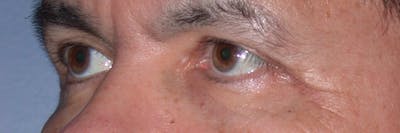 Eyelid Lift Before & After Gallery - Patient 4756964 - Image 4
