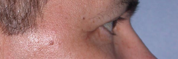 Eyelid Lift Before & After Gallery - Patient 4756964 - Image 6