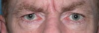 Eyelid Lift Gallery Before & After Gallery - Patient 4756968 - Image 1