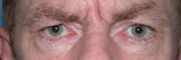 Eyelid Lift Gallery Before & After Gallery - Patient 4756968 - Image 1