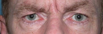 Eyelid Lift Gallery Before & After Gallery - Patient 4756968 - Image 1