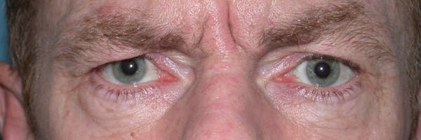 Eyelid Lift Gallery Before & After Gallery - Patient 4756968 - Image 1