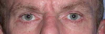 Eyelid Lift Gallery Before & After Gallery - Patient 4756968 - Image 2