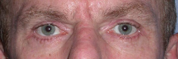 Eyelid Lift Before & After Gallery - Patient 4756968 - Image 2