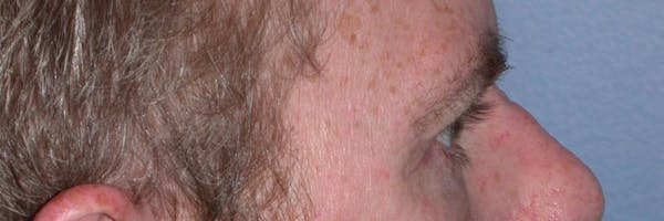 Eyelid Lift Gallery Before & After Gallery - Patient 4756968 - Image 6